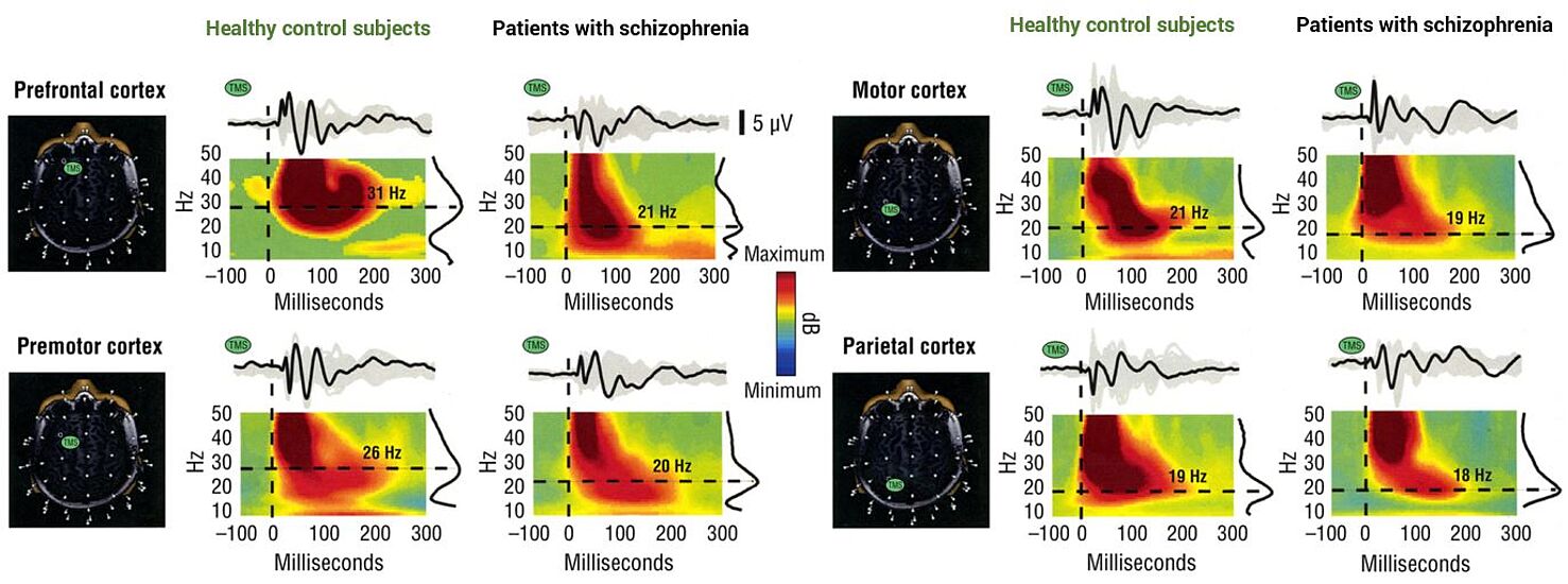 Patients with schizophrenia showed a reduction in several transcranial magnetic stimulation (TMS)–evoked fast oscillation parameters, including amplitude, duration, and frequency content in frontal cortical areas as shown by Ferrarelli et al. in 2012